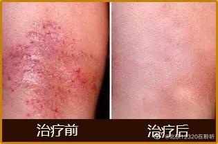 蛇盘疮,怎么治疗,最佳方法（带状疱疹的治疗有什么好方法吗）