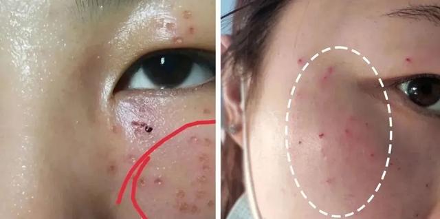 脂肪粒沐浴就消逝下眼睑脂肪粒会自己消逝吗