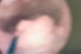 小伙喉咙痛有异物感，发现问题不简单图片