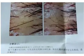 头油头痒，竟然需要去医院做检查？头上长了这种虫卵要当心图片