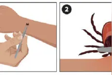 发现蜱虫叮咬后怎么办？能拍死吗？图片