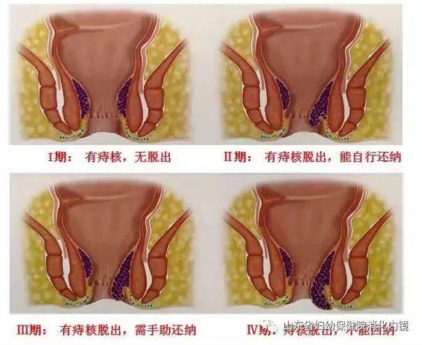 内痔疮的最佳治疗方法（山东省妇幼两种治疗内痔的新型方法）