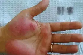 杭州32岁小伙去相亲，女孩父亲一看他手掌：相亲缓缓，你赶紧去医院查查吧图片