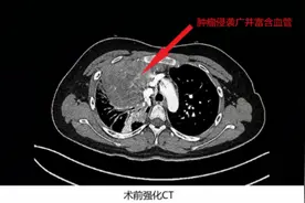 13岁少女右前胸疼痛难忍，竟是卵黄囊瘤！中心医院手术切除图片