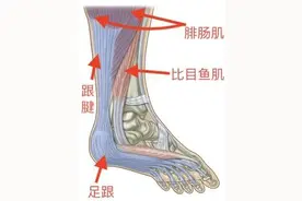 总是足跟痛？你可能患上了跟腱炎图片