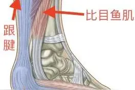 总是足跟痛？你可能患上了跟腱炎图片