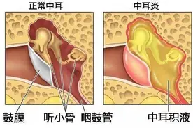 流感高发季出现耳闷，小心是分泌性中耳炎，重可致聋图片
