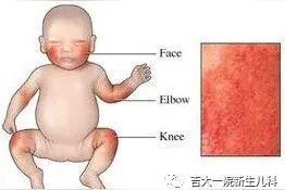 新冠疫情防控期间 新生儿照护小贴士丨婴儿湿疹图片