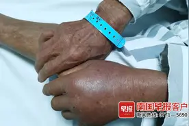 毒蛇出没！崇左一老汉被眼镜王蛇咬伤，左手迅速肿胀，专家提醒应该这样做→图片