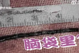 女大学生吃药调理月经致颅内血栓，药物中有这类物质一定要注意图片