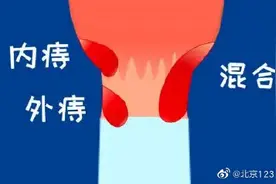关于痔疮的那些事图片