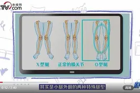腿粗、双腿之间有很大缝隙？你需要了解一下小腿外翻图片