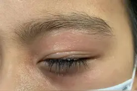 深圳8岁男童做手工，左眼被502胶水粘住睁不开了图片