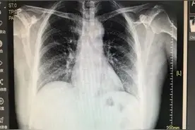 男子不能躺着睡觉，喝水都吐，全因心太大……图片
