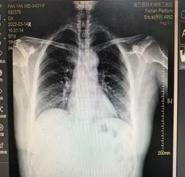 男子不能躺着睡觉，喝水都吐，全因心太大……