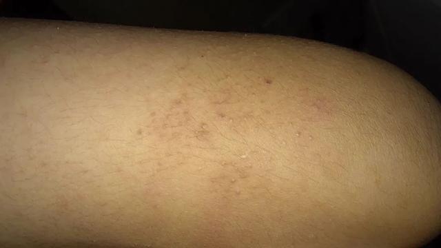 鸡皮肤要去角质嘛