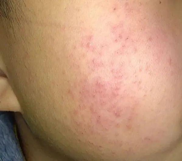 鸡皮肤要去角质嘛