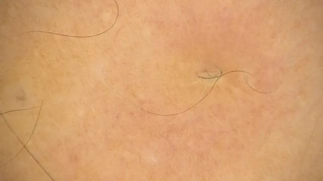 鸡皮肤要去角质嘛