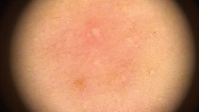 鸡皮肤要去角质嘛