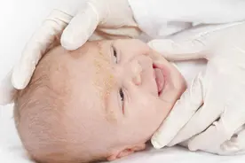 孩子眼中的一个白点竟是恶性肿瘤？专家提醒：此病多发于3岁以下婴幼儿图片