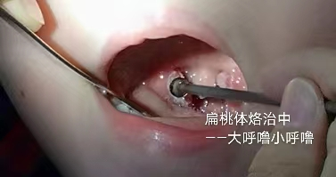 扁桃体角化症针灸