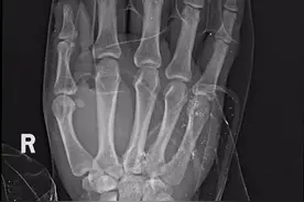 男子右手臂完全离断，医生成功接上断臂图片