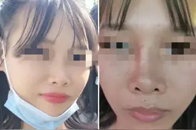 女子贷款3万整出“歪鼻子”，机构：系喝酒抽烟所致图片