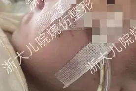 几个月大的宝宝就整了下巴？专家提醒，宝宝这些特殊面容可能有生命危险图片