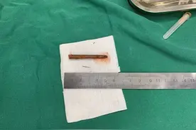 被筷子刺伤流泪不止，手术时发现眼中竟“藏“着5厘米长断筷图片