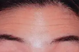 肉毒毒素注射：面部年轻化治疗的第一步图片