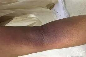 杭州50多岁阿姨大腿惊现红斑、水疱，竟是被它咬伤！这种虫子专爱咬人大腿图片