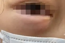 浙江10岁女孩眼睛里取出3条活虫，竟是因为撸了流浪猫？这几点一定要注意图片