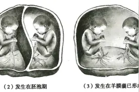 高危！双胞胎妈妈腹内脐带打结，被迫减胎成功分娩出健康女婴图片