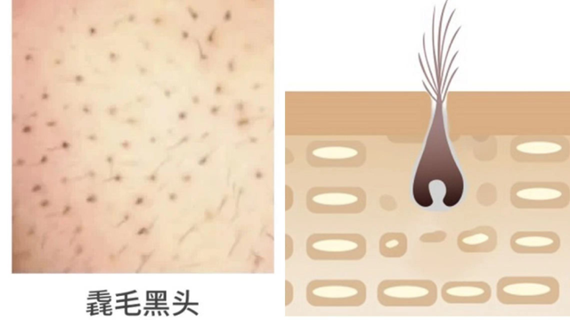 阿达帕林去黑头