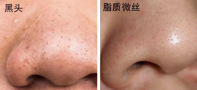 阿达帕林去黑头