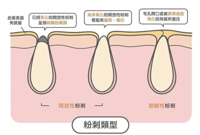 阿达帕林去黑头