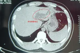 男子经常腹痛，人黄了，肝也差点搞没了！这个疾病不容忽视图片