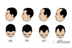 关于脱发你了解多少？图片