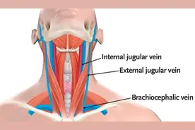 颈内静脉置管深度应该是多少？图片