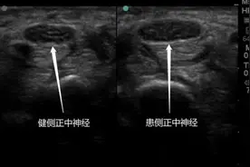 手发麻？可能是这个问题图片