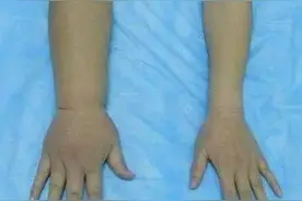 淋巴水肿，知多少图片