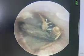 惊！昆明一男子熟睡时，飞蛾闯进耳朵里…图片