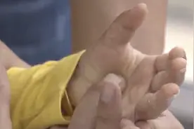 梅雨季节闷热潮湿 警惕“霉”出皮肤疾病图片