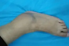 崴了脚要不要看医生？图片