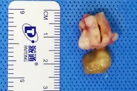 珠海一女子脑里长寄生虫，竟是长期吃鱼生所致？图片