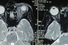眶内木质异物图片
