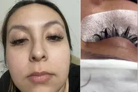 国外女子嫁接假睫毛险些失明图片