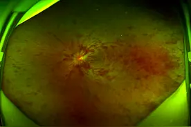 长沙男子醉酒后醒来眼底出血险失明！专家：疑因长期饮酒导致图片