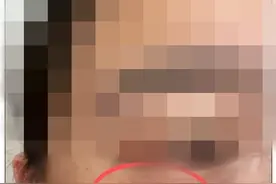 毒液堪比硫酸，沾到或致毁容！这种虫子上热搜，厦门曾有人中招……图片