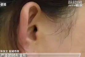 江苏盐城女子隆鼻手术后，右耳朵却变形了？图片